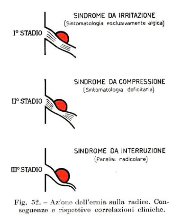 Irritazione delle radici nervose