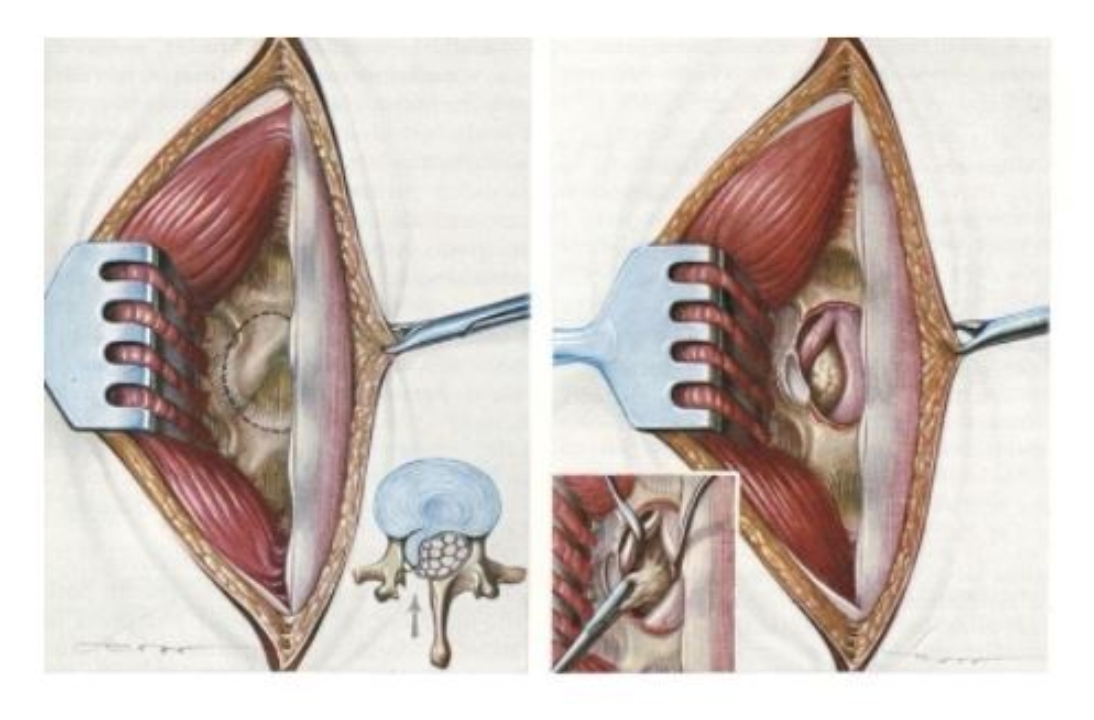 Terapia invasiva