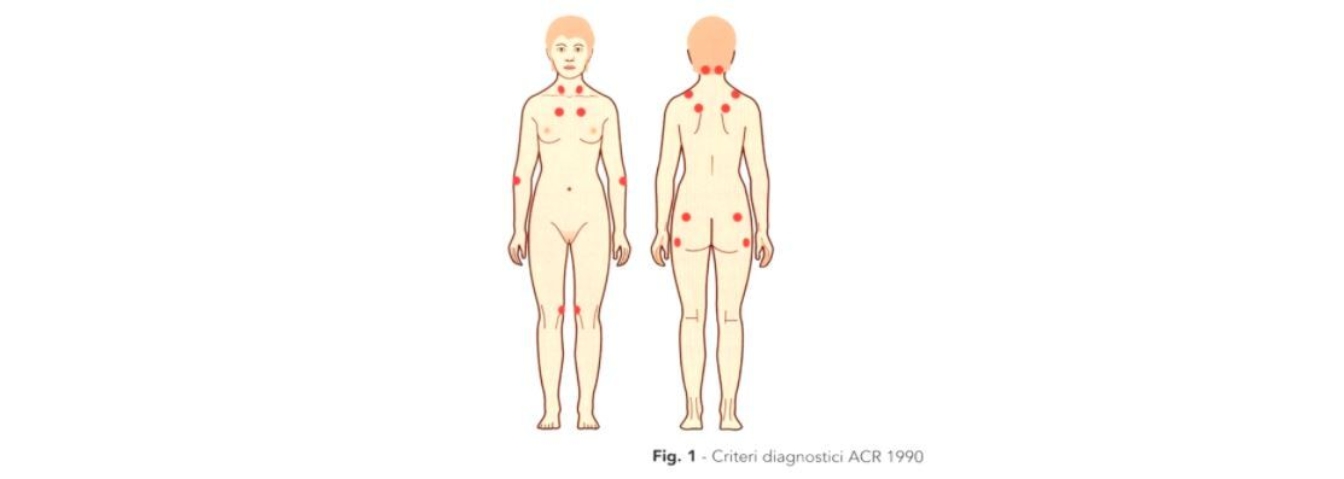 Trigger points fibromialgia