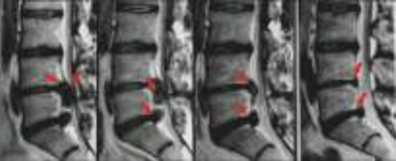 Trattamento discopatia della colonna con ossigeno ozonoterapia
